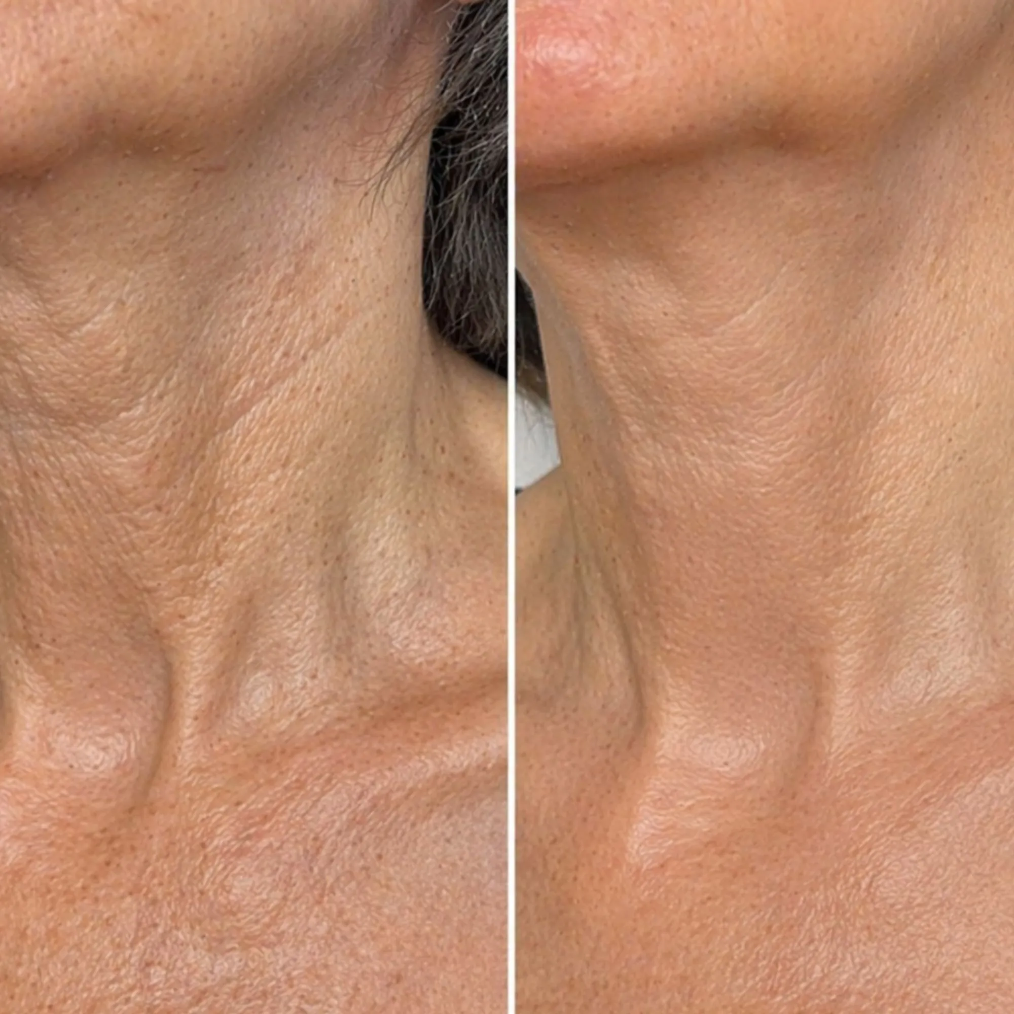 Before and after comparison of neck skin showing reduced wrinkles after using Riversol Retinol Neck Cream